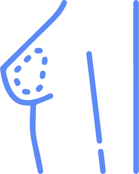 Mamoplastia de reducción